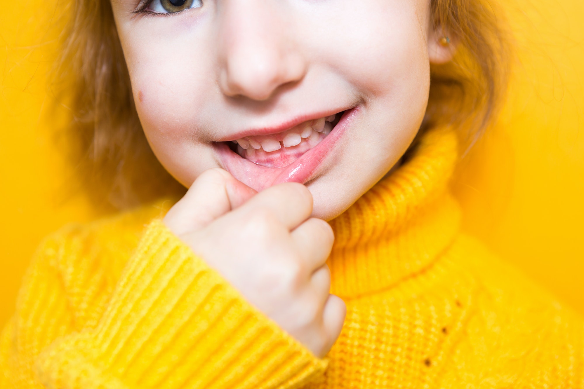 Girl shows her teeth-pathological bite, malocclusion, overbite. Pediatric dentistry