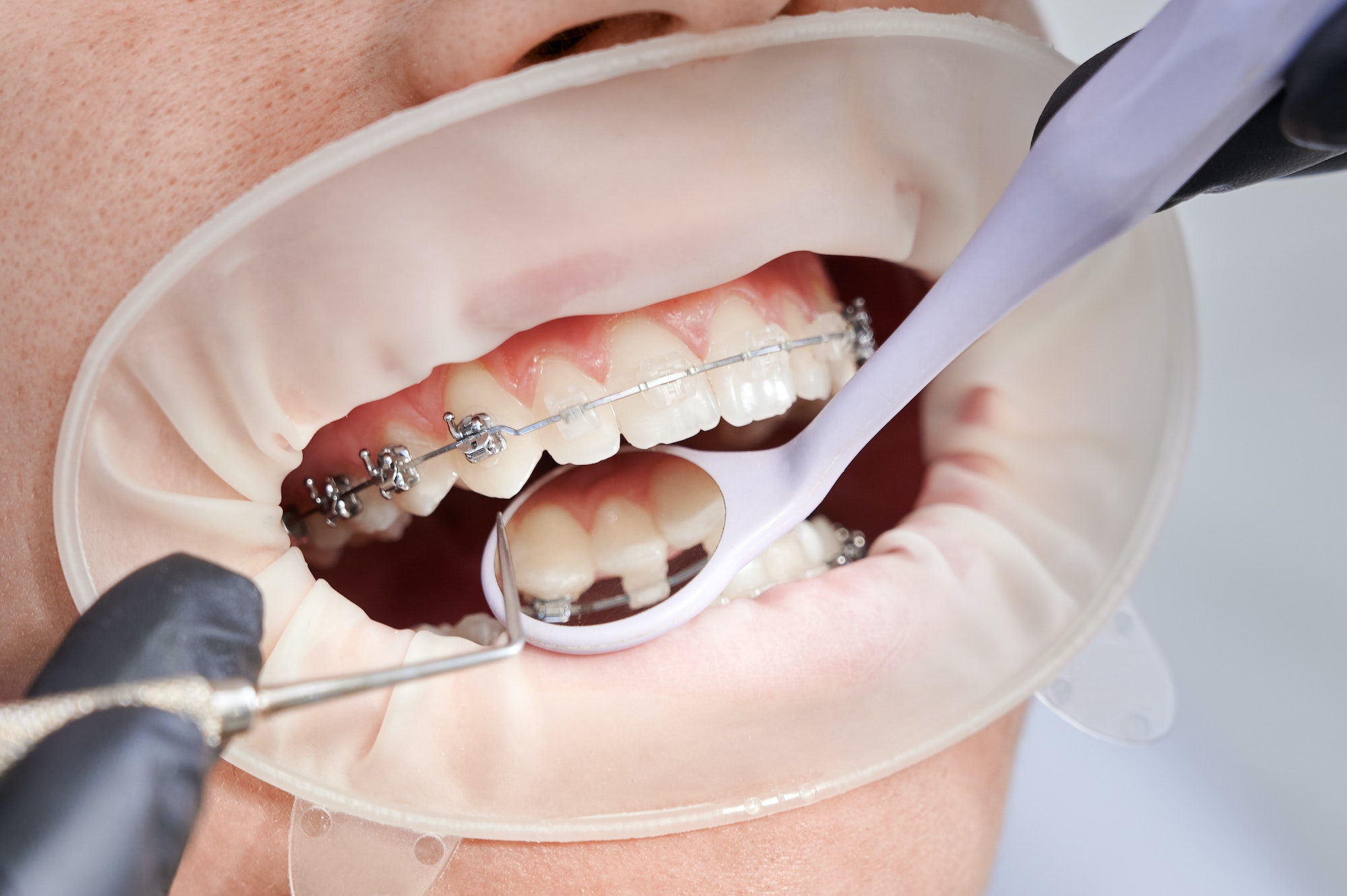 Dentist attaching metal braces to patient teeth.